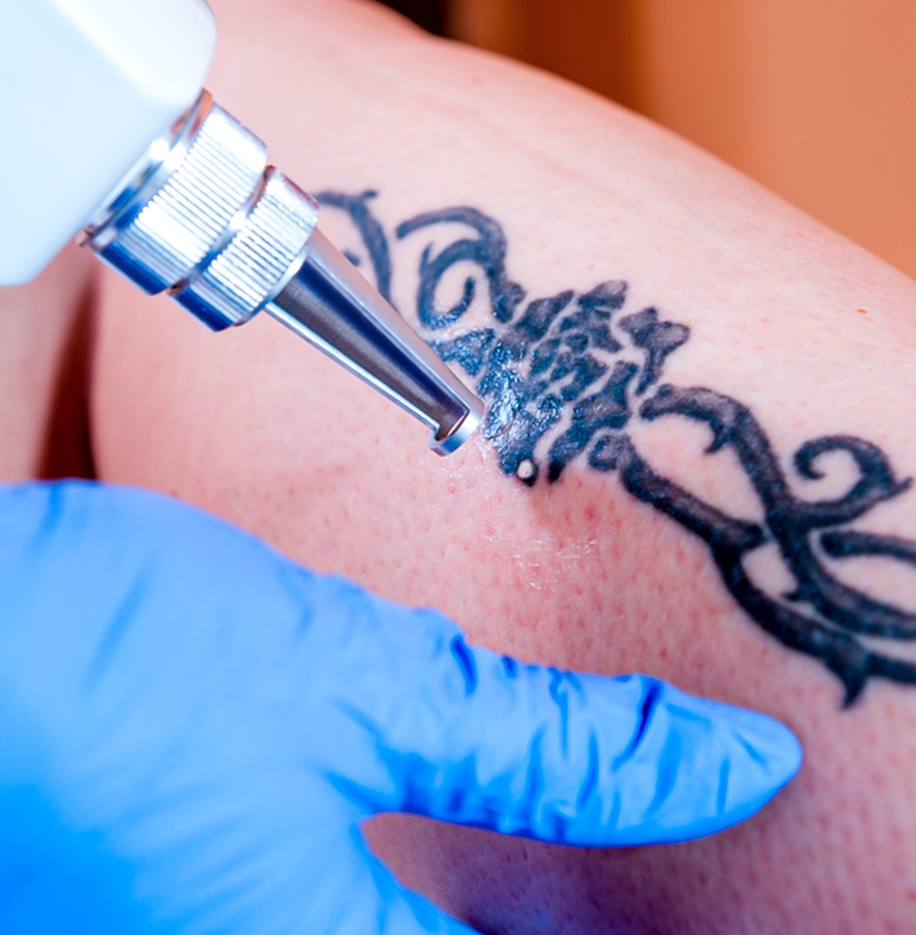 Eliminacion de tatuajes